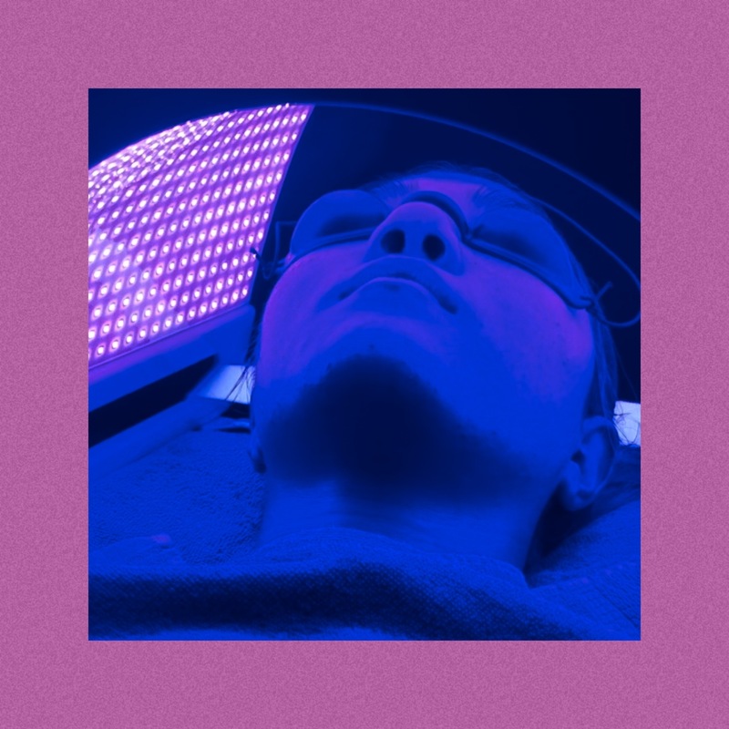 Acne treatment w microneedle CBD and blue LED